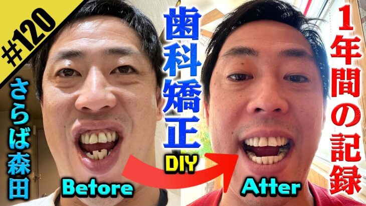 【画像】さらば森田の歯、一年の歯科矯正でめちゃくちゃ綺麗になるｗｗｗｗｗｗ