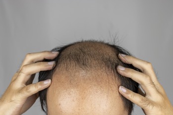 エナジードリンク、男性の抜け毛が増えることが判明