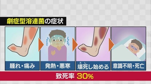 【致死率３０％】人喰いバクテリア・溶連菌感染症のニュースに対して医者「抗生物質も抗菌薬も足りてない」