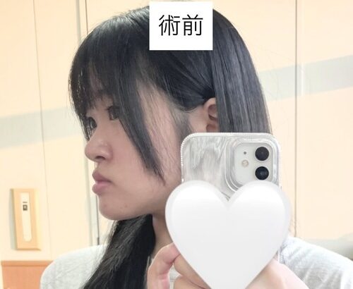 顎変形症の女性が整形手術をした結果ビフォーアフター